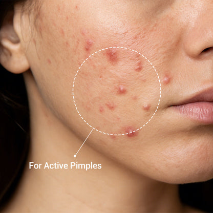 Dr. Leo Acne Drying Lotion