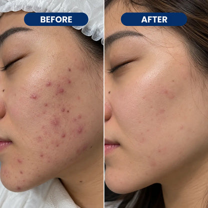 Dr. Leo Acne Drying Lotion